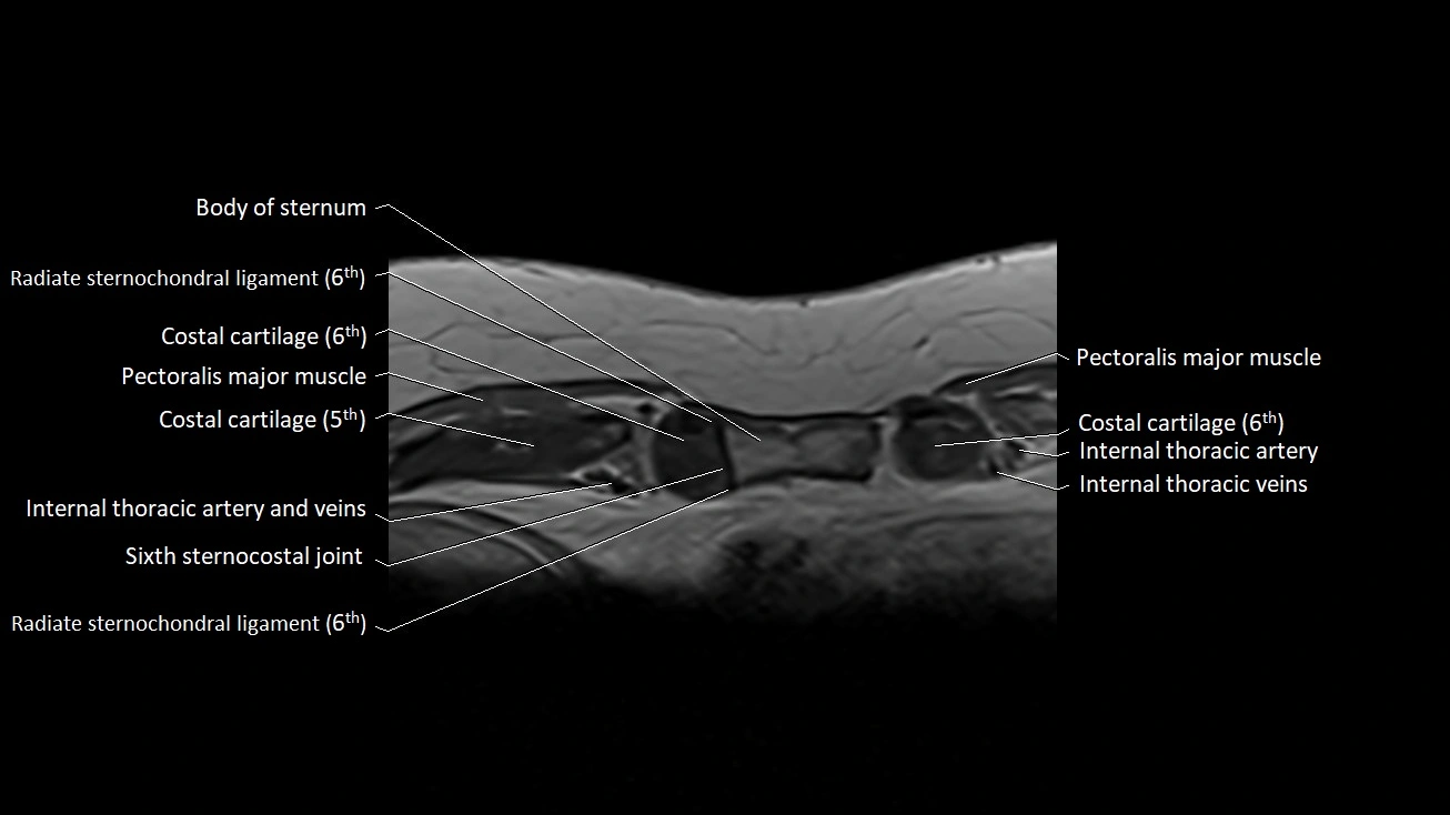MRI sternum and sternoclavicular joint labeled axial anatomy image 33.webp